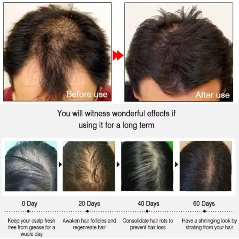 Hair Growth Serum 7 Days Fast Regrowth Essential Capsule Anti Hair loss Baldness Repair Damaged Scalp Treatment For Women Men