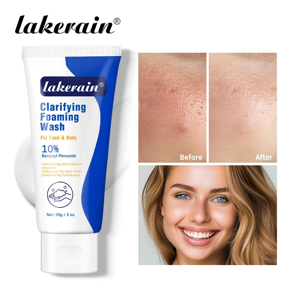 Acne Foaming Wash Benzoyl Peroxide 10% Maximum Antimicrobia Oil-Control Reduces Redness Deep Cleaning for Face & Body Skincare