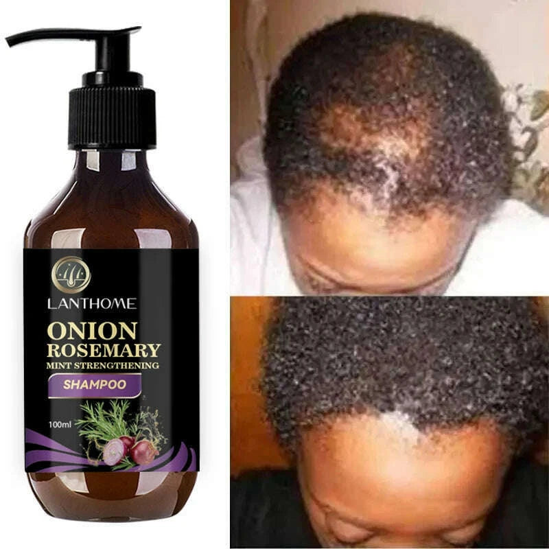 100ml-hair-shampoo-for-fast-hair-growth-rosemary-onion-shampoo-30ml-spray-anti-hair-loss-effective-within-7-day-hair-growthkimlud-womens-fashion-34608538