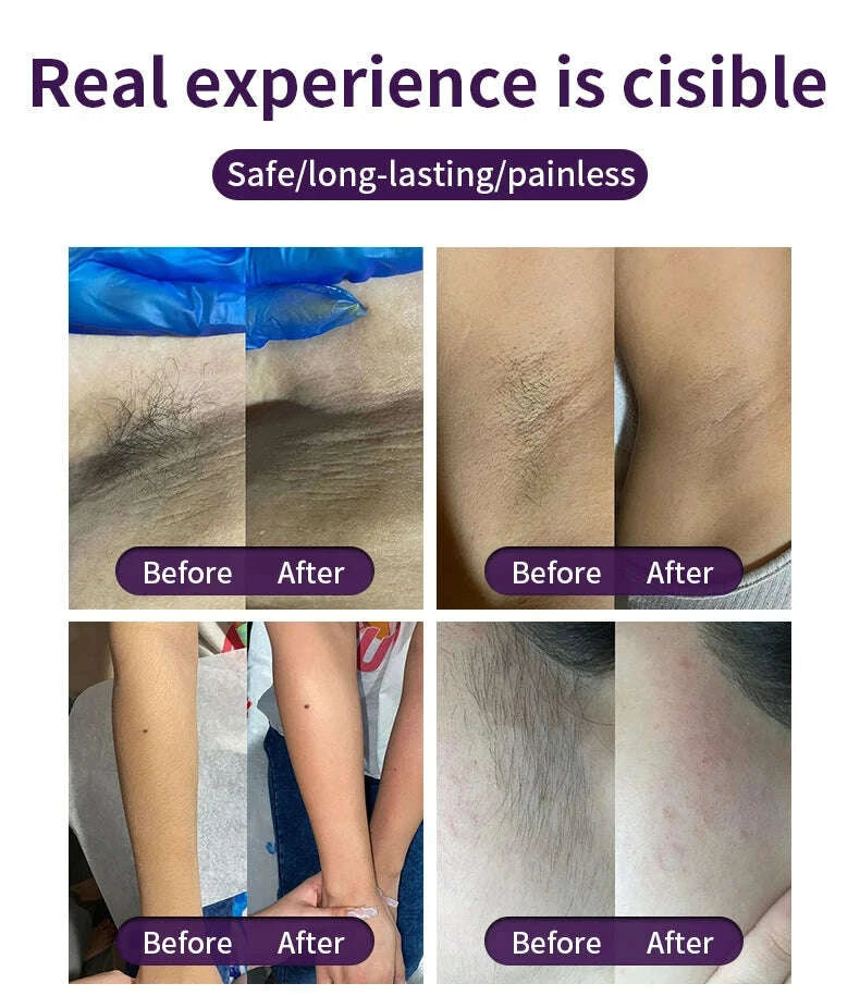 KIMLUD, Medical CE Certified 4 Wavelength 755nm/940nm/1064nm/808nm Skin Rejuvenation Hair Removal High Diode Laser Hair Removal Machine, KIMLUD Womens Clothes