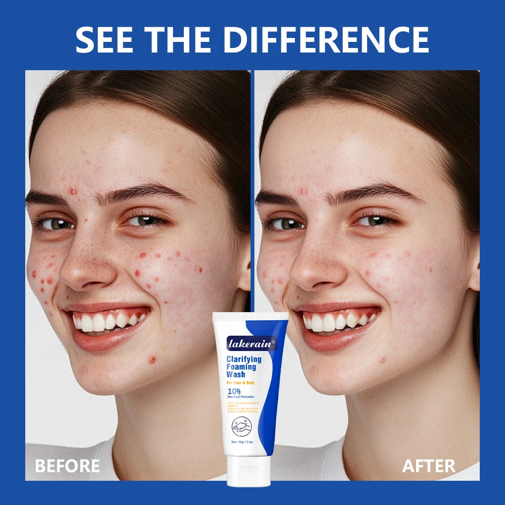 Acne Foaming Wash Benzoyl Peroxide 10% Maximum Antimicrobia Oil-Control Reduces Redness Deep Cleaning for Face & Body Skincare