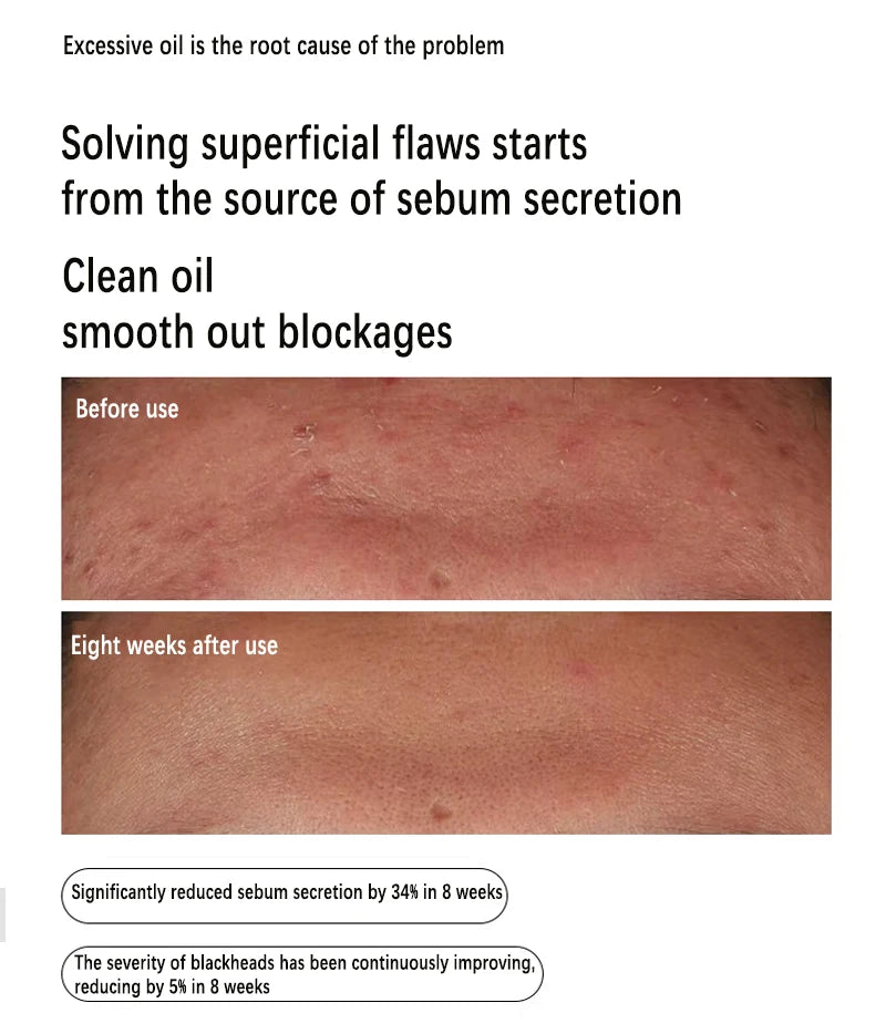Niacinamide 10% Zinc 1% Serum Oil-Control For Oily Skin — Clear | KIMLUD