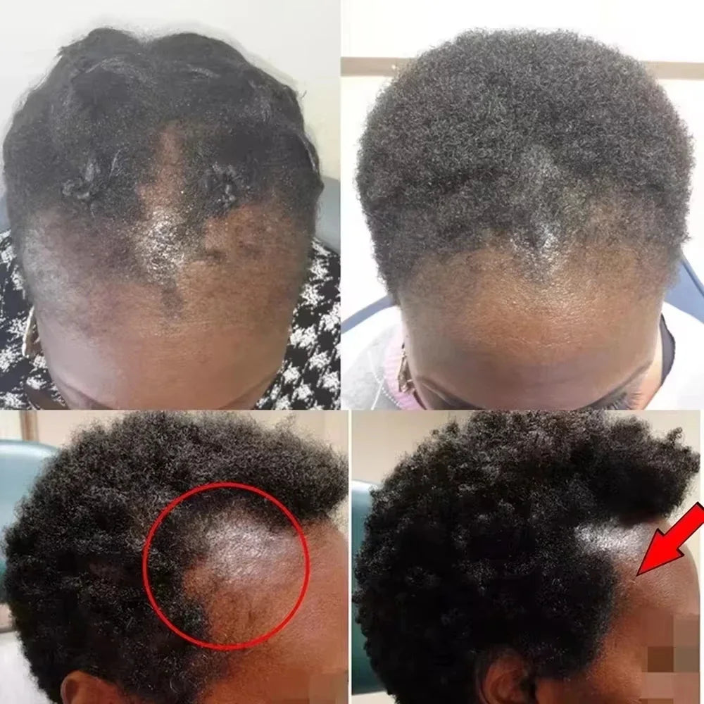 Batana Oil Hair Growth Set Traction Alopecia Treatment Anti-Hair Loss — Golden Amber | KIMLUD