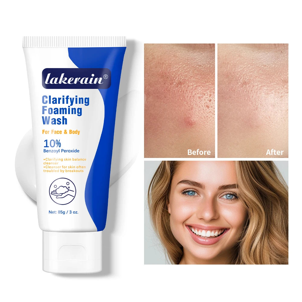 Acne Foaming Wash Benzoyl Peroxide 10% Maximum Antimicrobia Moisturizers reduces redness For Face & Body Skin Care Face Wash