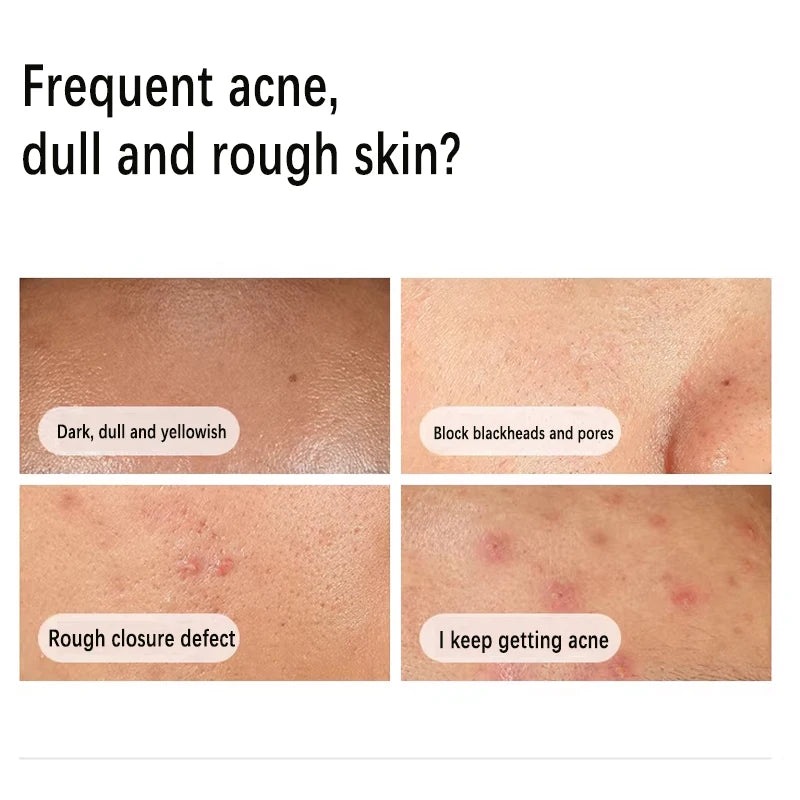 Niacinamide 10% Zinc 1% Serum Oil-Control For Oily Skin — Clear | KIMLUD