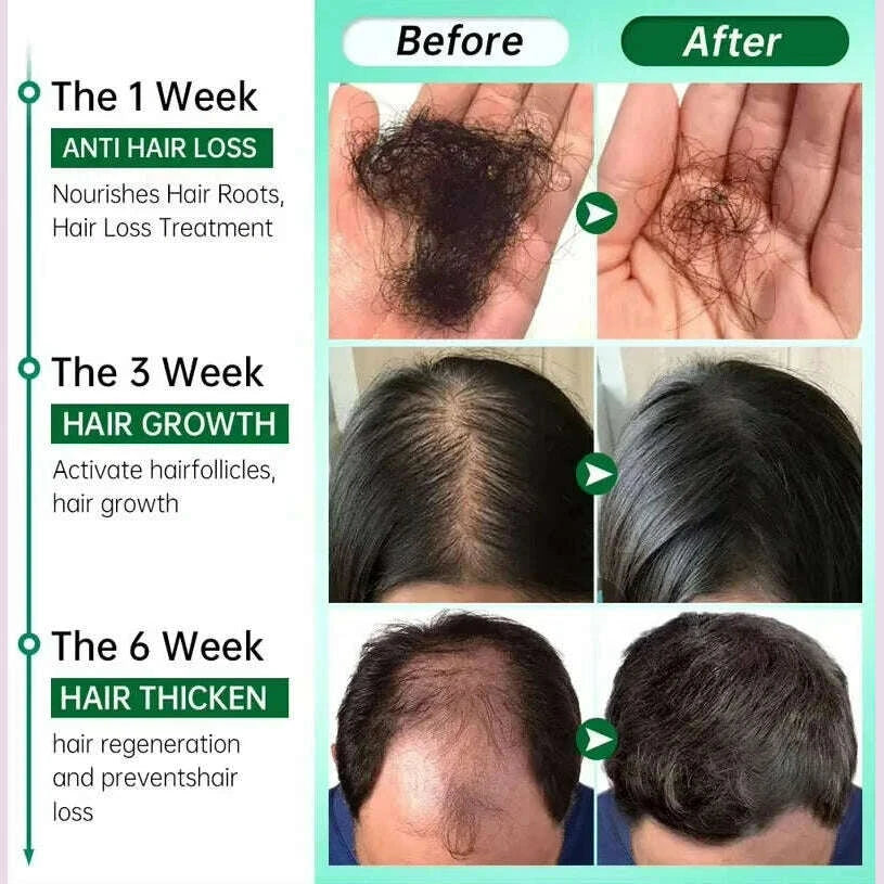 hair-growth-serum-7-days-fast-regrowth-essential-capsule-anti-hair-loss-baldness-repair-damaged-scalp-treatment-for-women-menkimlud-womens-fashion-34619625