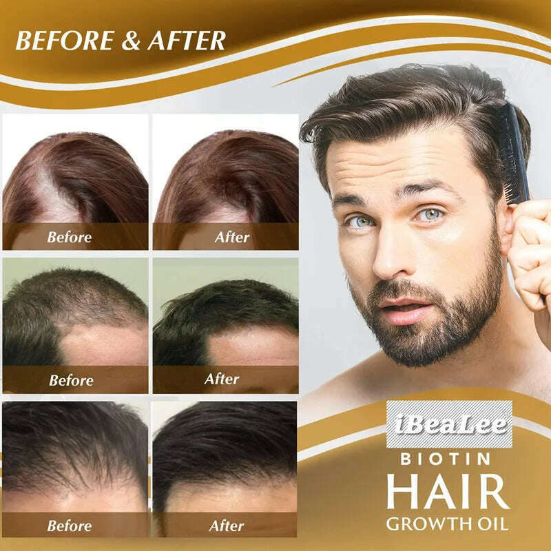 KIMLUD, Anti Hair Loss Serum Fast Hair Growth Spray Products Prevent Baldness Treatment Scalp Dry Damaged Beard Hair Care Essential Oils, KIMLUD Women's Clothes