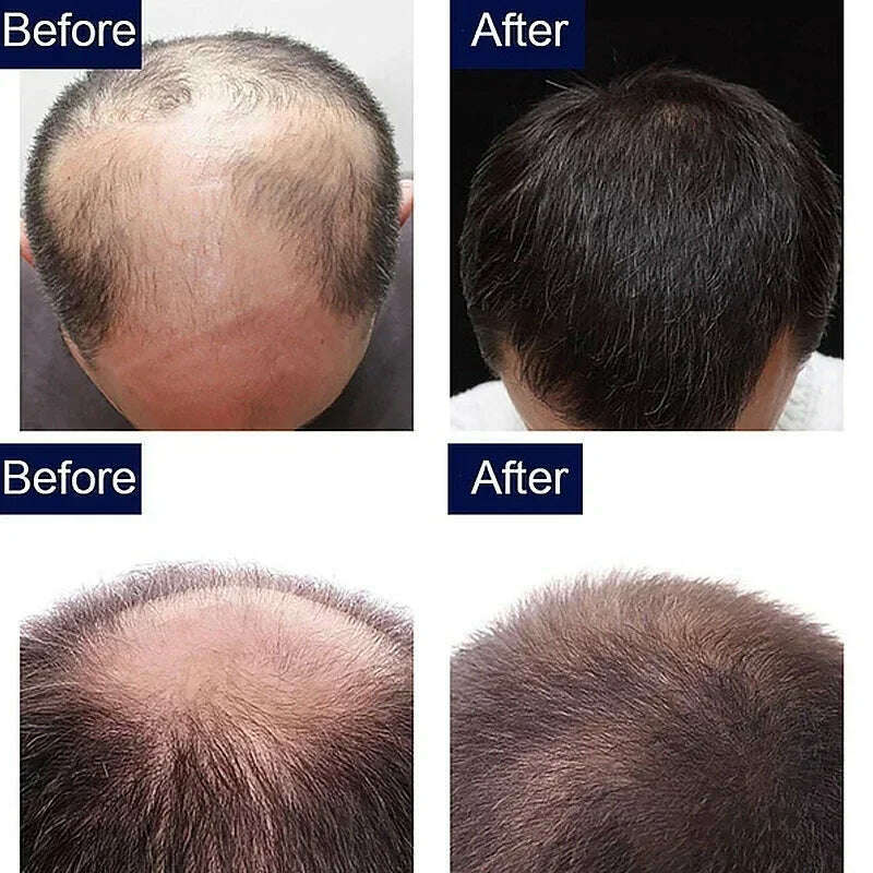 KIMLUD, Fast Hair Growth Oil Ginger Growth Hair Treatment Anti Hair Loss Men Women Scalp Treatment Serum Products Beauty Health Product, KIMLUD Women's Clothes