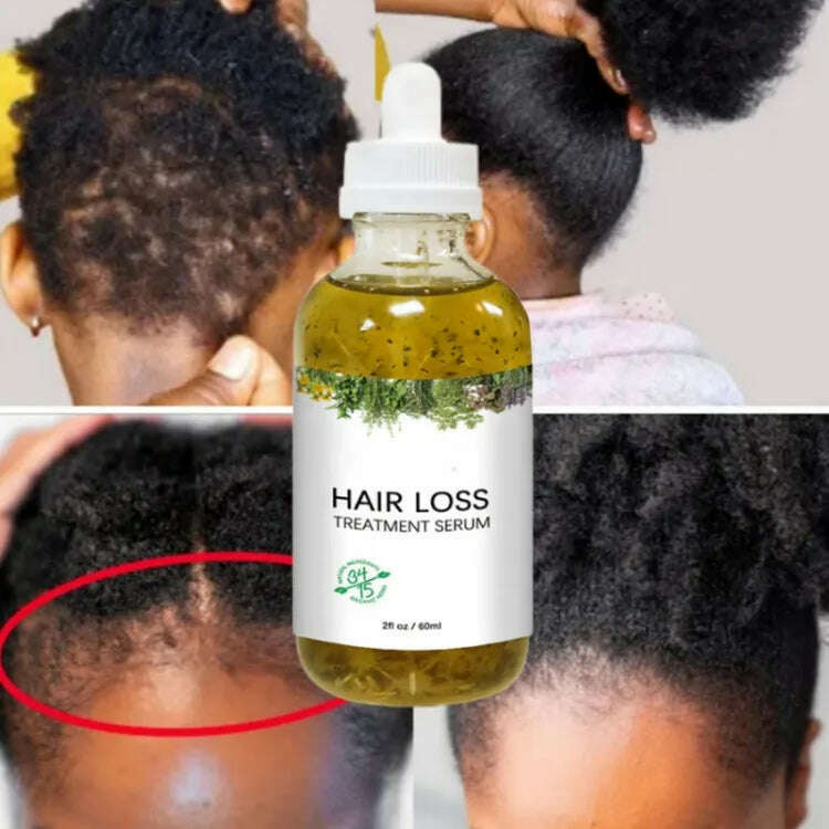 KIMLUD, New Fast Hair Growth Serum 100% African Crazy Traction Alopecia Anti Hair Loss Essential Prevents Bald Thinnin Hair Care Oil, KIMLUD Womens Clothes